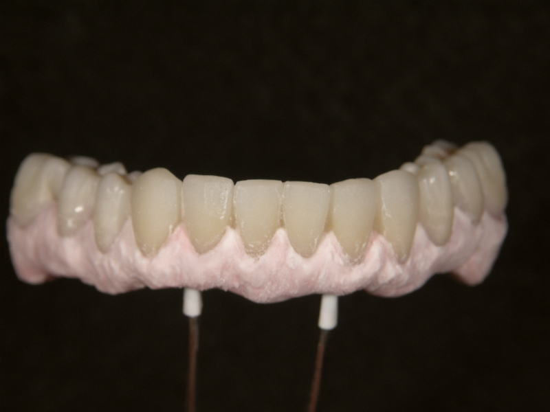 歯冠部形態修正後、ガム色陶材築盛