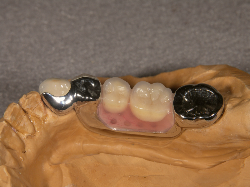 中間歯欠損ケース　3⏋Mini SG   7⏋頭ぬきコーヌス　