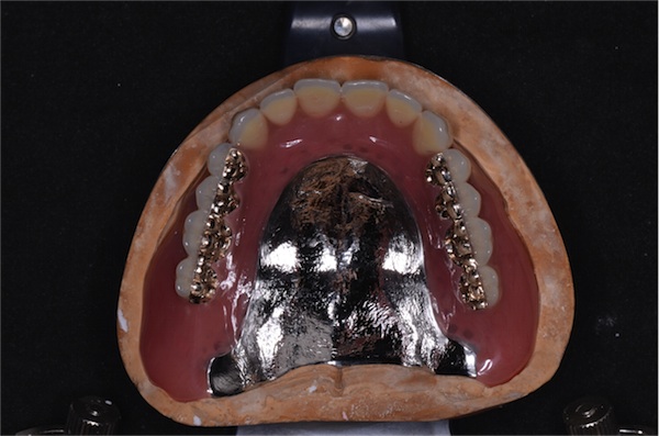 金属床義歯（金属ブレード 歯を使用）